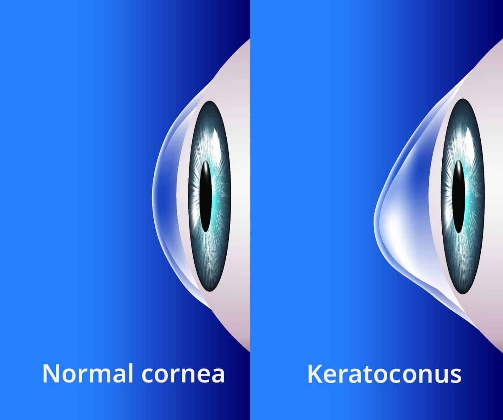 Keratoconus Vision For Life Institute