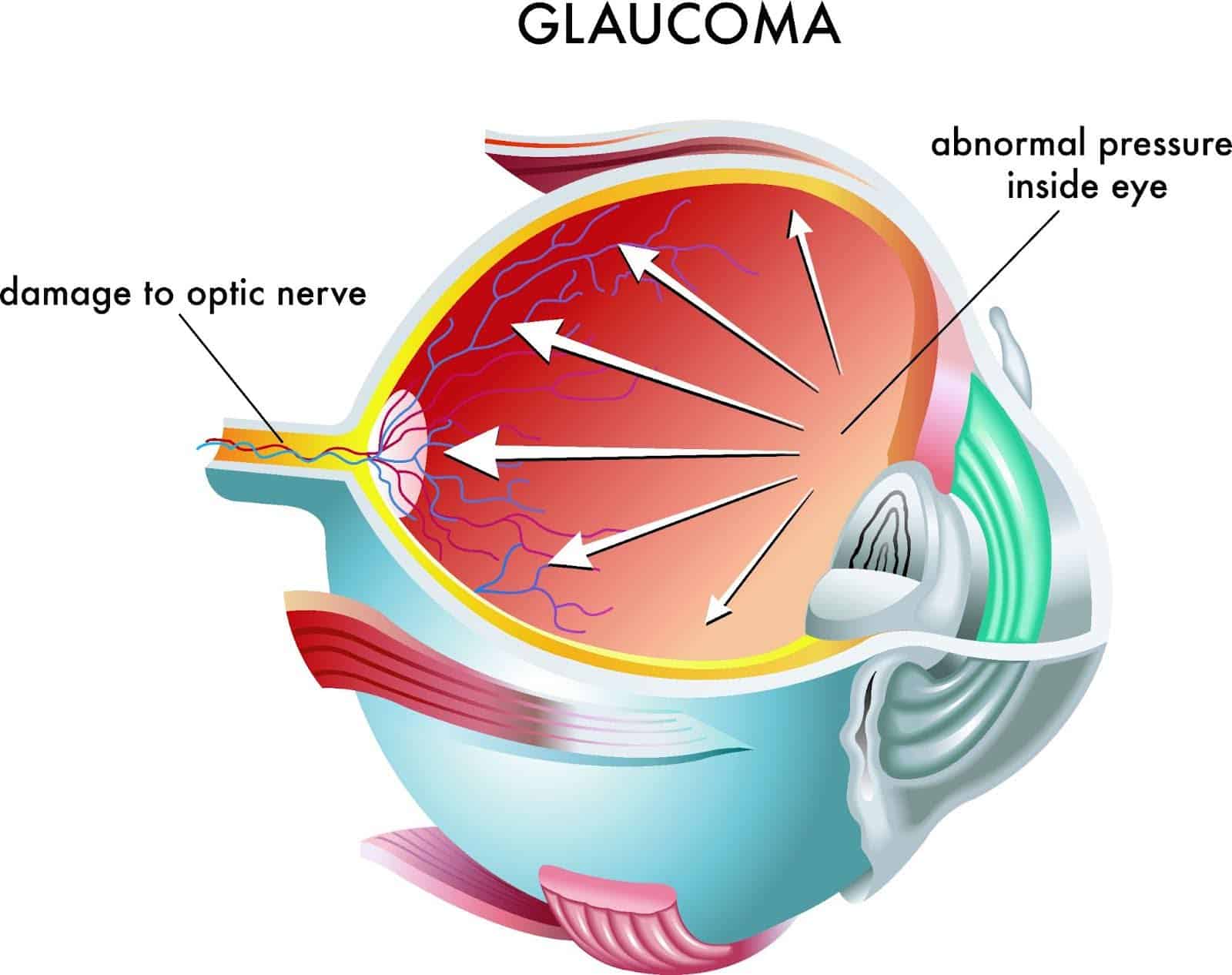 Selective Laser Trabeculoplasty